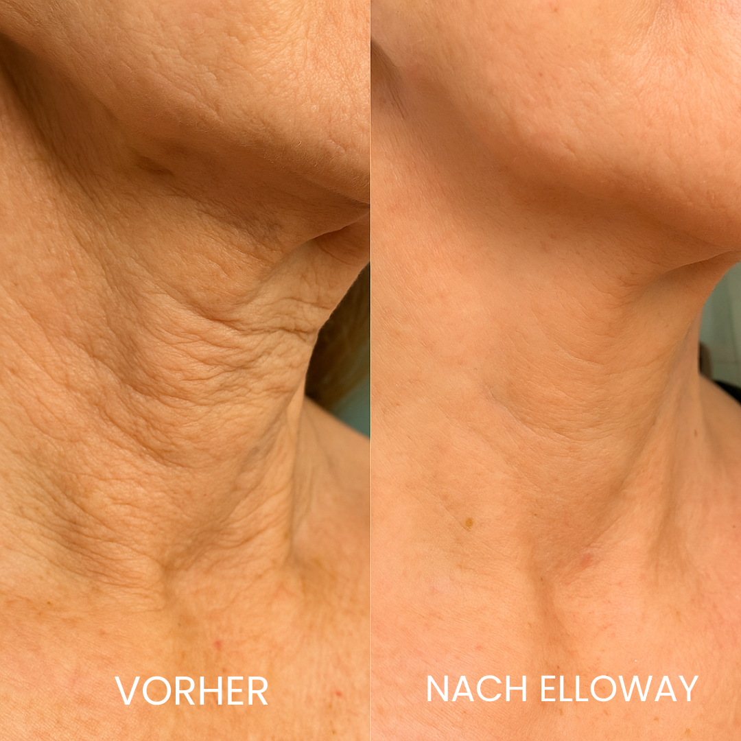 Elloway Derma Infusion Therapy
