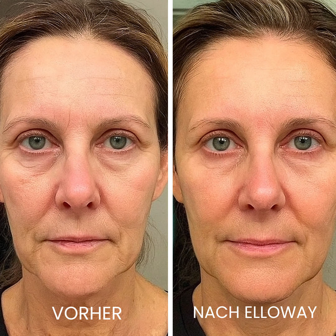 Elloway Derma Infusion Therapy