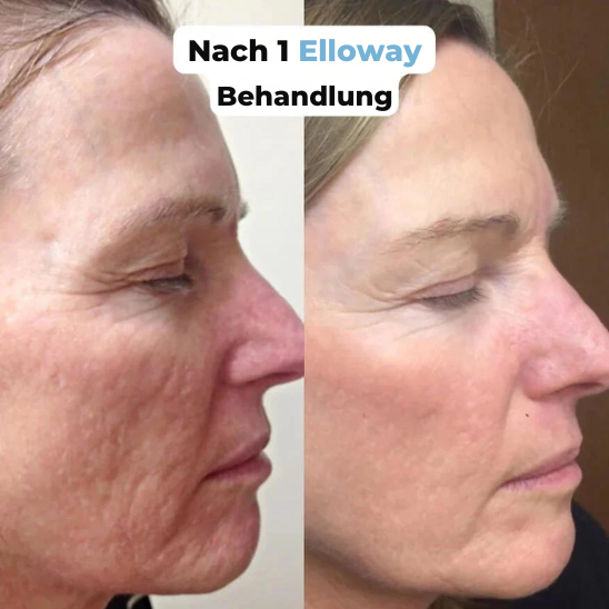 Elloway Mikroinfusionstherapie