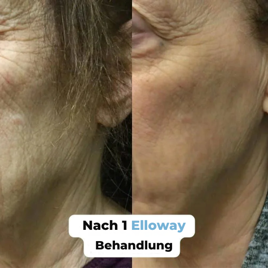 Elloway Mikroinfusionstherapie