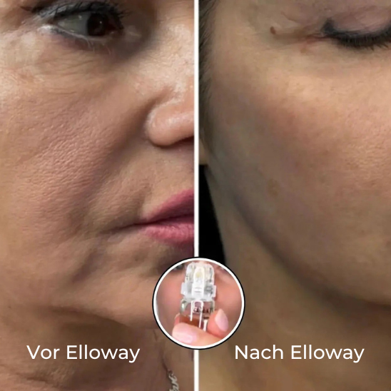 Elloway Mikroinfusionstherapie