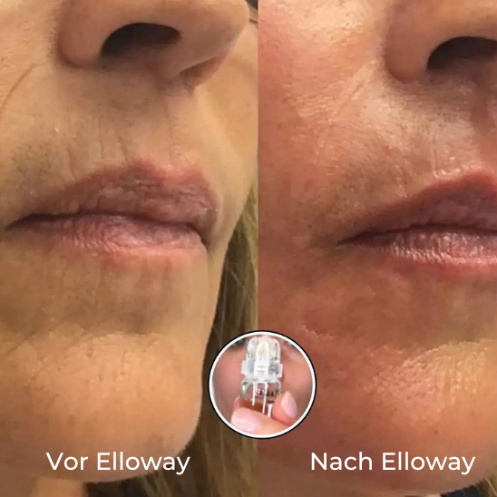 Elloway Mikroinfusionstherapie