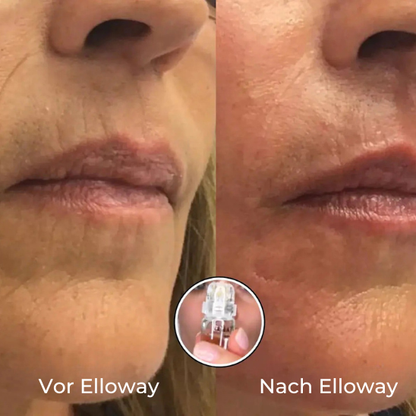 Elloway Mikroinfusionstherapie